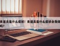 食道炎是什么症状！食道炎是什么症状会发烧吗？
